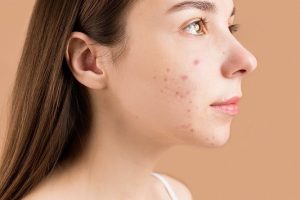 Does Your Diet Really Impact Acne?
